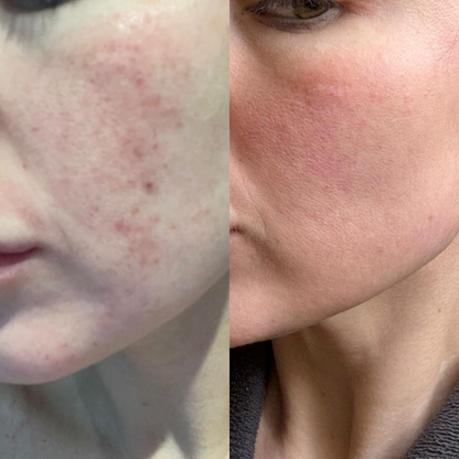 Clearer Skin From Your First Shower — Without Expensive Creams, Prescriptions, or Another Skincare Routine